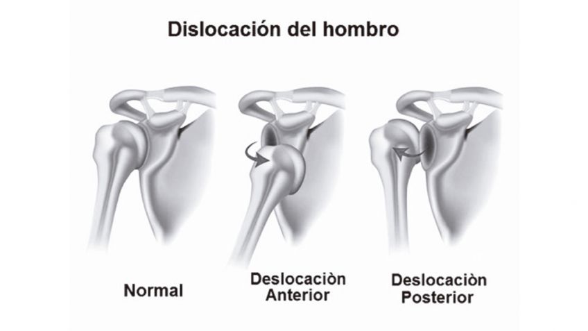 Luxación en el hombro