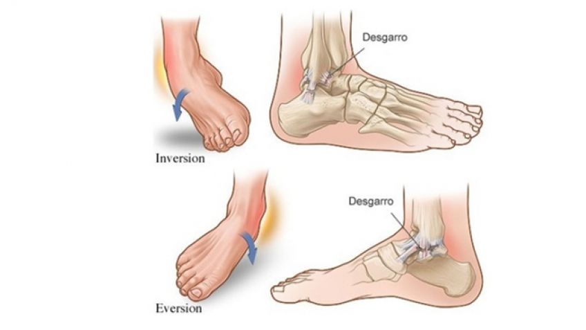 ¿Esguince de tobillo o caminar por la vida?