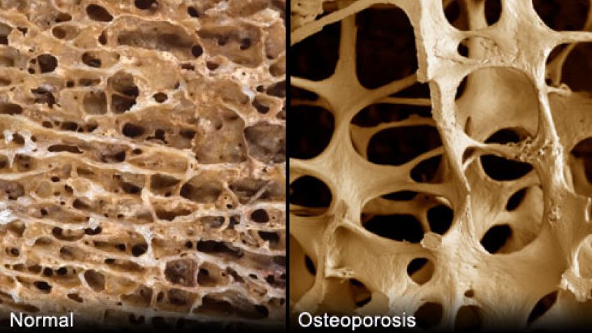 Osteoporosis  en el varón 