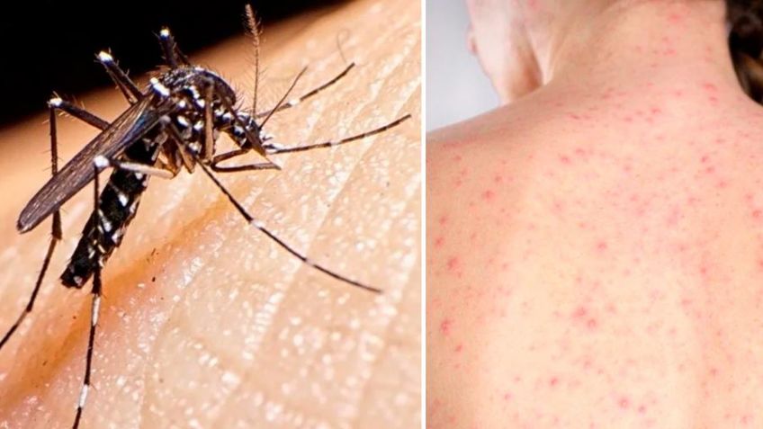 Dos muertos confirmados por dengue y sarampión en la provincia