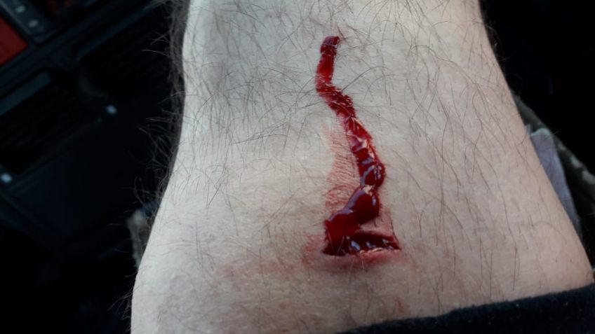 Otro recolector resultó herido por un vidrio arrojado en una bolsa
