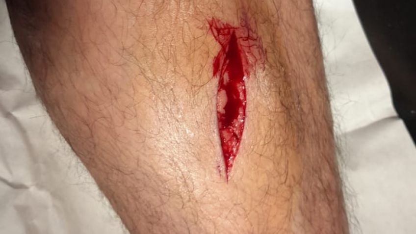 Recolector sufrió importante corte por un vidrio indebidamente sacado con los residuos